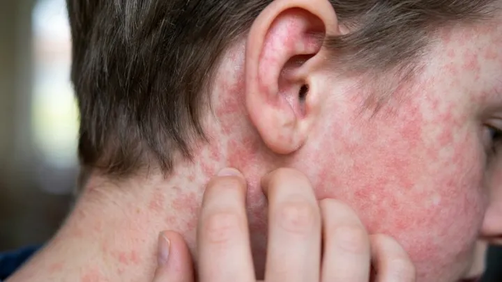 Measles case confirmed in Queen Creek