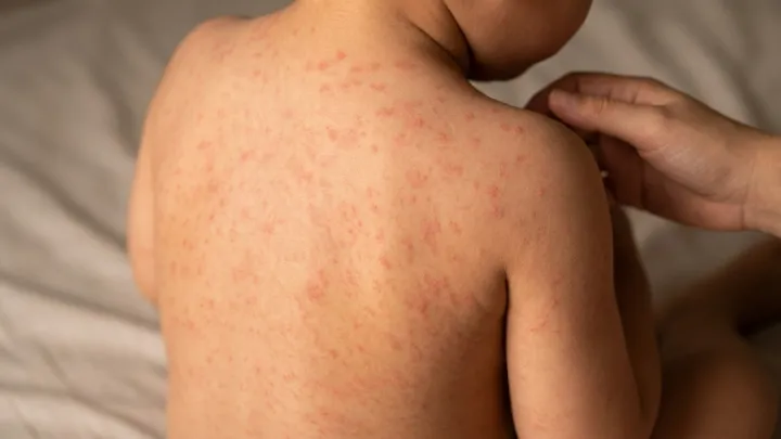 Sixth measles case confirmed in Maricopa County