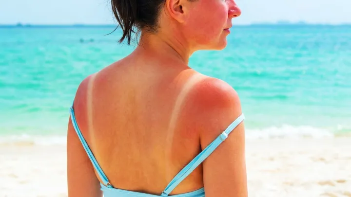 Sunburn Textbooks Face a Radical Rewrite