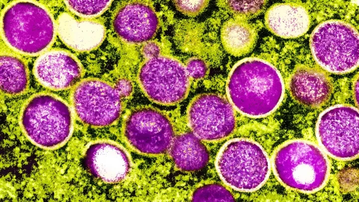 California on alert as mpox infections climb