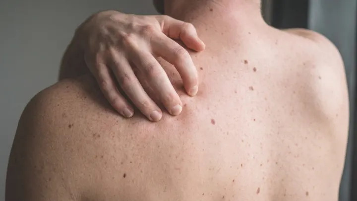 Spotting Melanoma Before It Turns Lethal