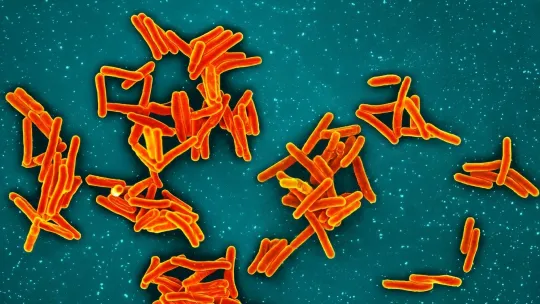 TB outbreak exposes hidden school risk