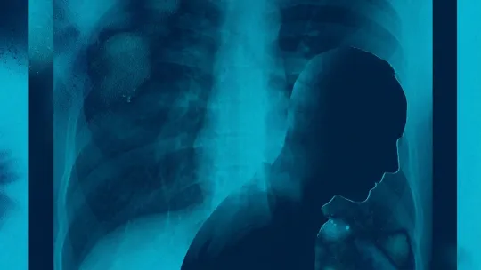 The Quiet Failure in Metastatic Lung Cancer