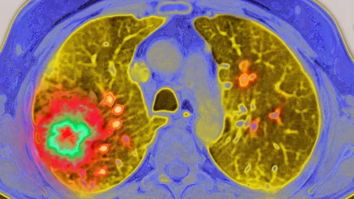 GLP-1 drugs linked to slower cancer spread