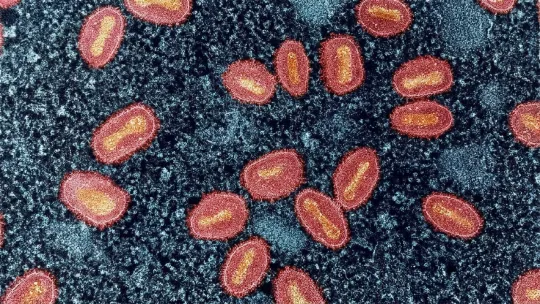 Wisconsin flags mpox cases and urges prevention