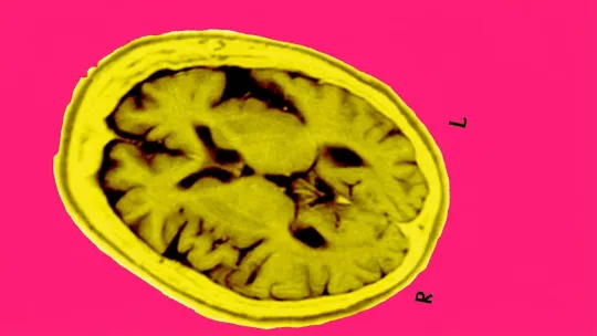 Blood Test Flags Early Cognitive Decline