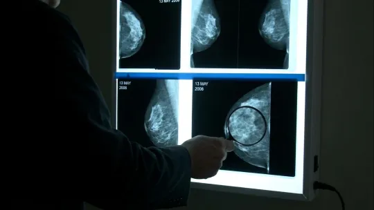 Genomic score test may cut chemo use