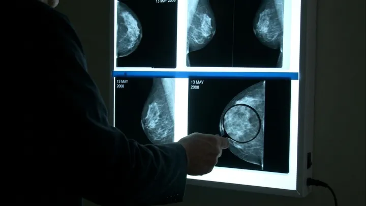 Genomic score test may cut chemo use