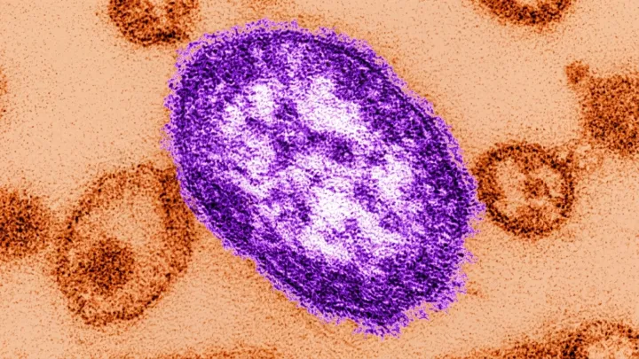 Connecticut logs first measles case