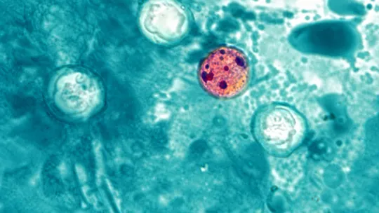 Michigan Tracks Quiet Spread of Cyclosporiasis