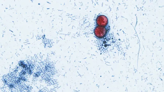 Explosive diarrhea parasite spreads in Kentuckiana