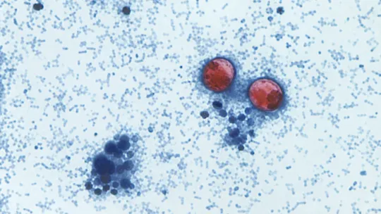 Cyclosporiasis surge triggers probe in New York
