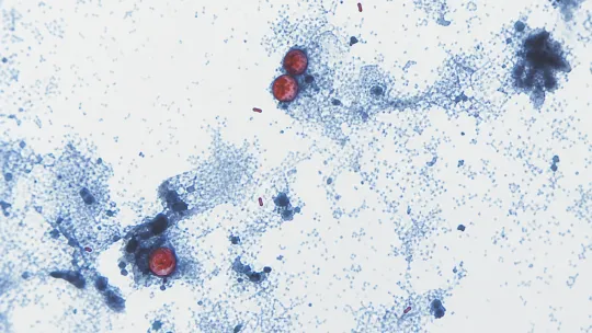 Parasitic stomach illness spreads in Louisiana