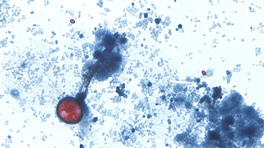 Cyclosporiasis Diarrhea Outbreak Widens
