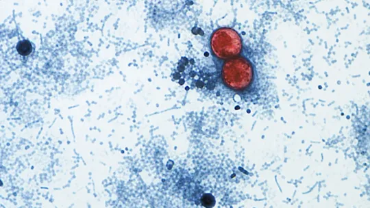 Maryland Cyclospora Cases Spike Again