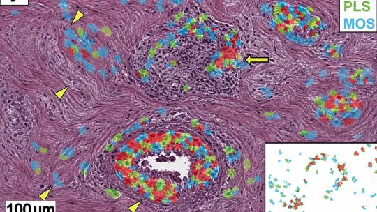 Is Cancer A Quantum Disease?