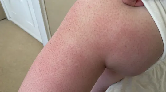 Heat From Screens Marks Young Skin