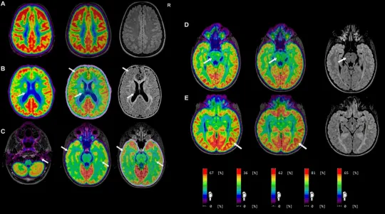 PET/MRI Finds Hidden Seizure Sources