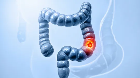 Why Younger Adults Face More Colorectal Cancer